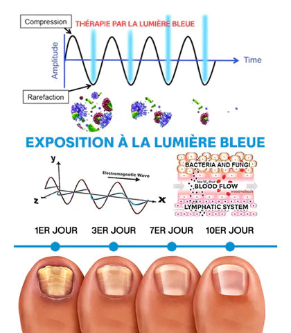 Appareil de traitement au laser pour champignon des ongles