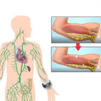 Bracelet d'Amincissement à Ultrasons